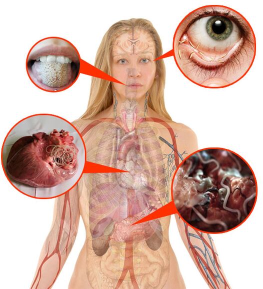 Parásitos y gusanos en el cuerpo humano. 